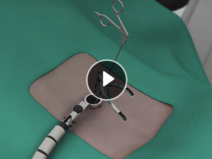 Spine Surgery Video